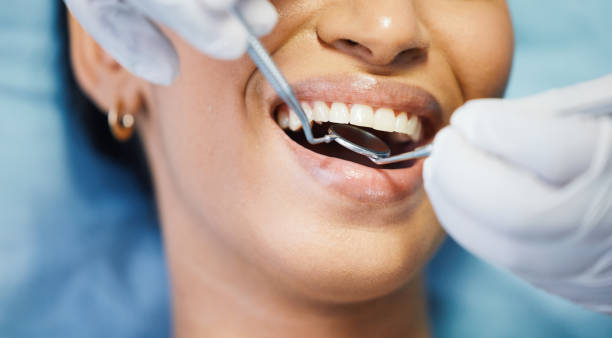 Best Emergency Wisdom Teeth Removal in Pandora, OH