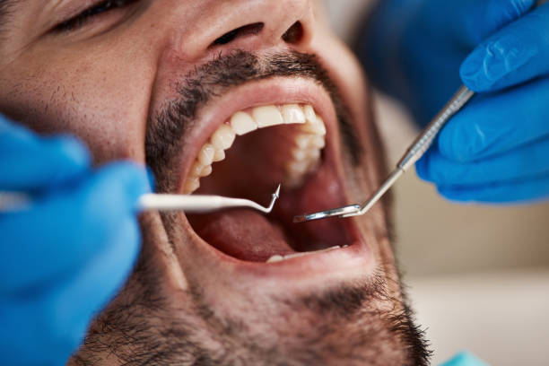 Best Emergency Wisdom Teeth Removal in Pandora, OH